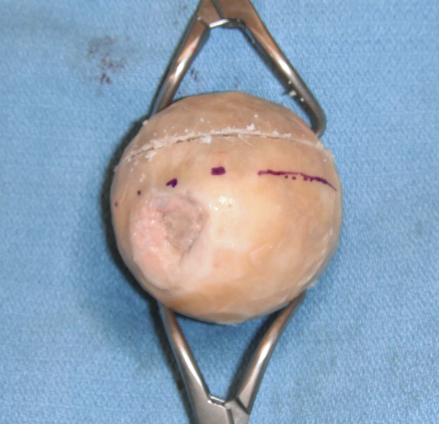 Femoral Head Allograft 1